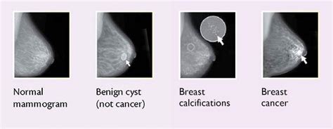 do breast buds go away|lump in breast after period.